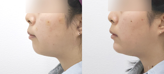 before & after